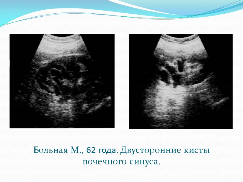 Больная М., 62 года. Двусторонние кисты почечного синуса.